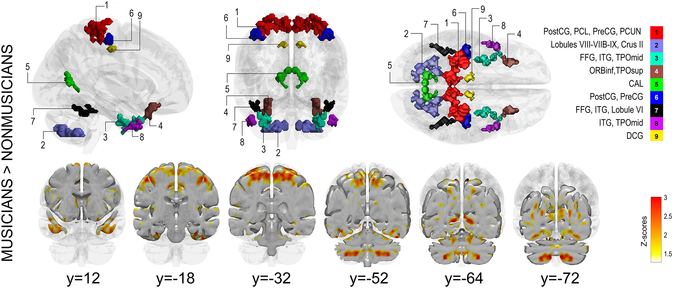 Brain maps from Burunat and colleagues showing regions where musicians had greater interhemispheric functional symmetry than non-musicians while listening to music.