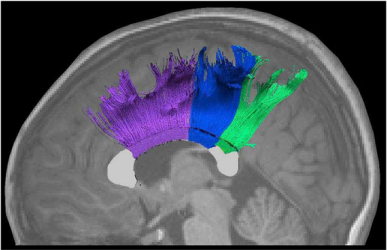 Side-view MRI with colored tractography showing corpus-callosum pathways connecting superior frontal, motor, and sensory areas.