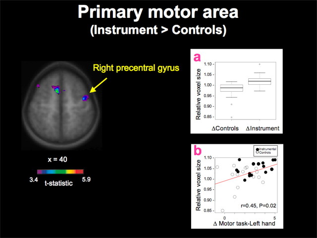 Hyde and colleagues’ Figure 1 showing greater relative structural change in the right precentral gyrus for children receiving instrumental training, with group and motor-improvement plots.