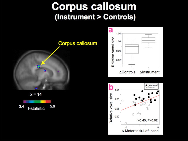 Hyde and colleagues’ Figure 2 showing greater relative structural change in the corpus callosum for children receiving instrumental training, with group and motor-improvement plots.