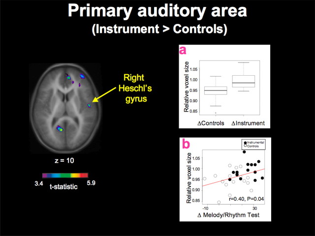 Hyde and colleagues’ Figure 3 showing greater relative structural change in the right Heschl’s gyrus for children receiving instrumental training, with group and melody-rhythm improvement plots.